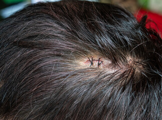 head injury treated by suture.