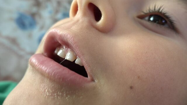 Fethiye, Turkey - 4th of November 2020: 4K Child with face affected by atopic disease yawns

