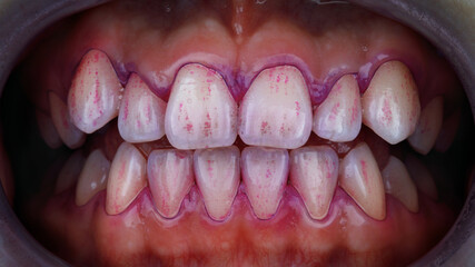 plaque indicator on teeth before professional cleaning by a dental hygienist