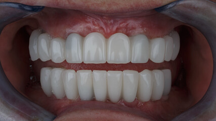 beautiful and even dental prostheses for temporary wear made of polymer, for the patient's lower and upper jaws © Dental Pro Content