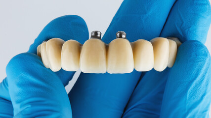 dental prosthesis for the entire upper jaw in the hand of the dentist, macro photo with a blue glove on a white background © Dental Pro Content