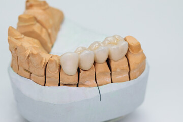 Metal ceramic bridge on a plaster model isolated on white background. Zirconium crowns veneers. Ceramic teeth with the veneers