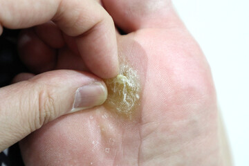 callus