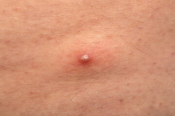 Fototapeta premium Hormonal disorder - acne on skin