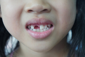 A girl smile with broken tooth,  showing a loose milk tooth. missing teeth.