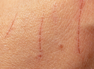 Scratches from the claws of a cat on human skin.