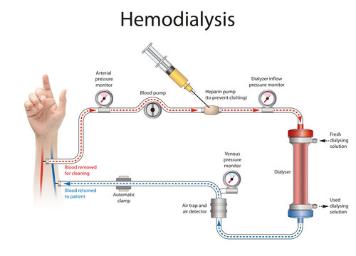 Hemodialysis or simply dialysis, is a process of purifying the blood of a person whose kidneys are not working normally