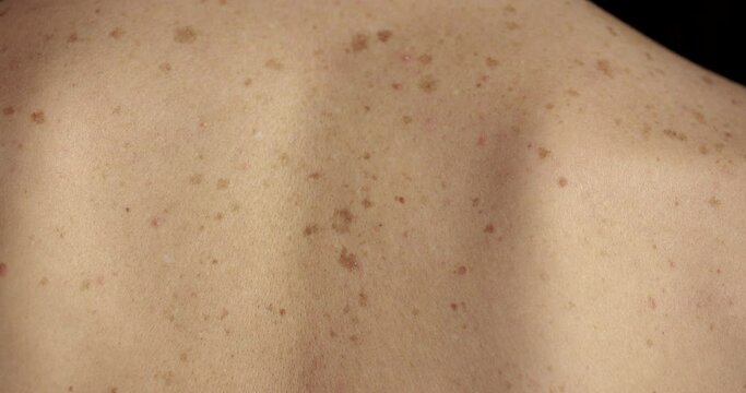 Close-up of large rashes or smallpox on the skin of an adult male. Pigmented spots on the back of a man. Skin of a man with moles. Acne. Problem skin. Skin care