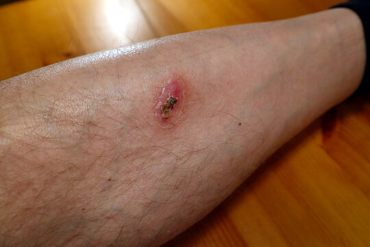 Isolated or close up of scab at a Swedish mans leg. From a small injury. Healing in process. Stockholm, Sweden.
