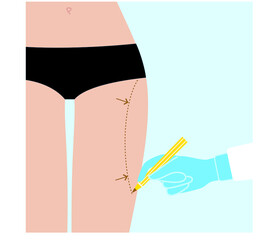 Woman hips plastic. Doctor making marks at the leg. Vector illustration