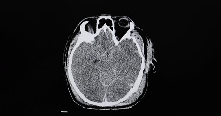 CT cine scan of a patient with falling injury showing severe depression fractures of skull, severe intracerebral hemorrhage, brain edema and herniation.