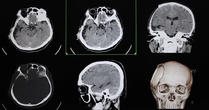 Multi screen CT cine scan of a patient post right craniectomy with encephalomalacic change of right brain hemisphere.