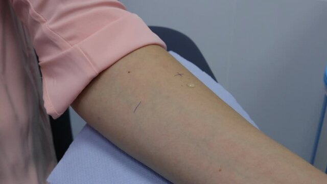 Allergy check. Application of allergens to the skin. Allergy testing