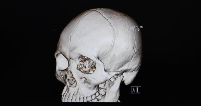 CT cine scan of a patient post right craniectomy with encephalomalacic change of right brain hemisphere.
