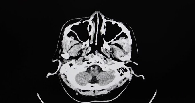 Multi screen CT cine scan of a patient post right craniectomy with encephalomalacic change of right brain hemisphere.
