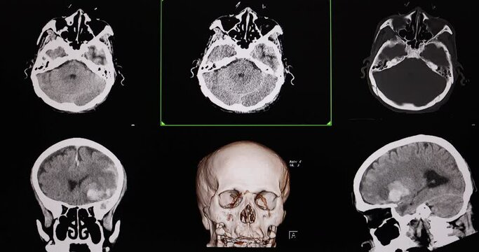 A CT cine scan of a traumatized patient showing intracerebral hemorrhage.