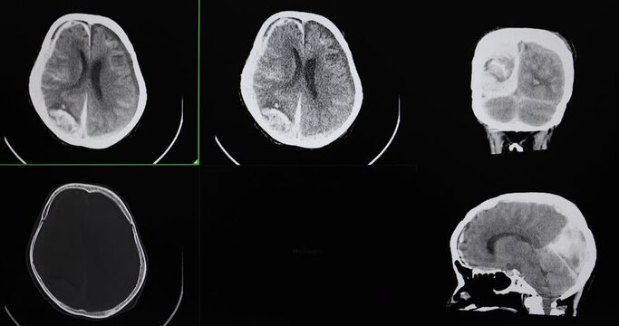 A CT cine scan of a traumatized patient showing intracerebral hemorrhage subdural and subarachnoid hemorrhage. 