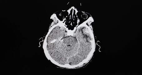 A CT cine scan of a traumatized patient showing intracerebral hemorrhage subdural and subarachnoid hemorrhage. 