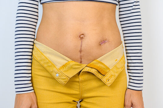 Close up of scars on stomach after surgery.
