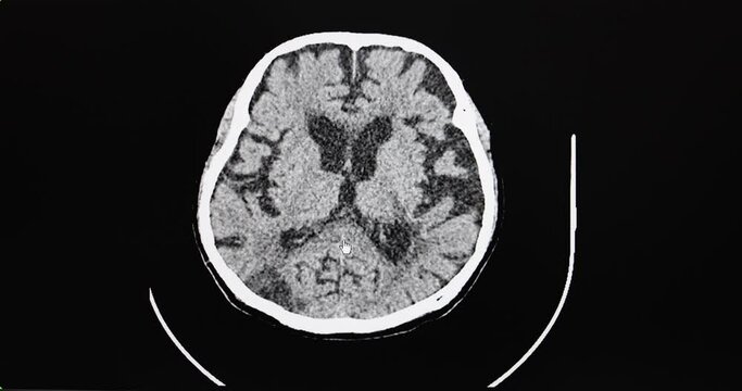 Brain CT cine scan of a patient with diffuse brain atrophy and old cerebral infarction.