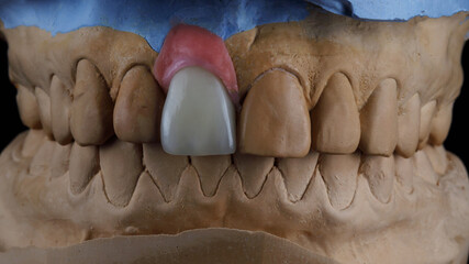 beautiful composition of dental crown made of zircon on a plaster model