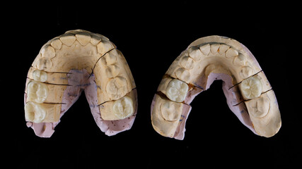 two dental models with ceramic crowns on the chewing teeth, shot from above on a black background