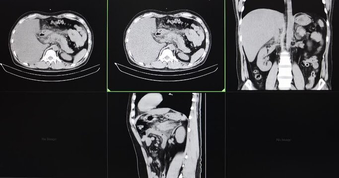 CT cine scan of an abdomen of a patient with acute pancreatitis, small gallstone and fatty liver.