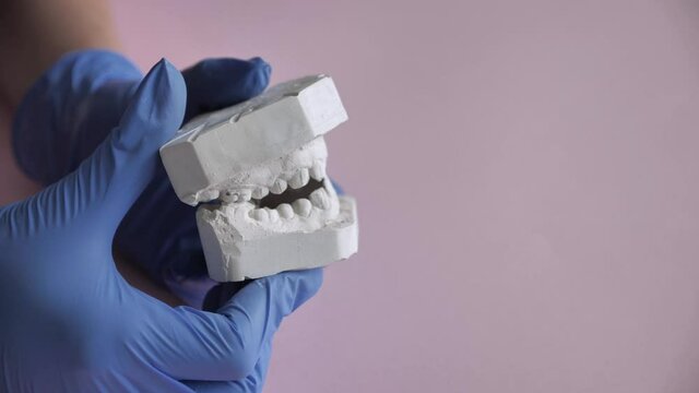 Gypsum model of the teeth before installing the bracket system. Doctor orthodontist in blue gloves closes and opens the plaster casts of the jaw, the chewing apparatus of the person. Side view