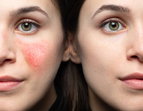 Rosacea before and after laser treatment. Successful removal from the face of a young Caucasian woman