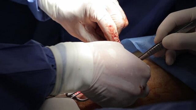 Surgeon doctor operating wearing special lamp lighting using electric cautery heart surgery intervention close-up, open cord surgery minimally invasive surgery