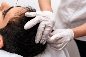 Man Receiving Acupuncture Treatment