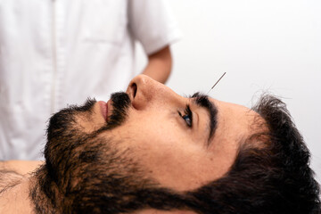 Man Receiving Acupuncture Treatment