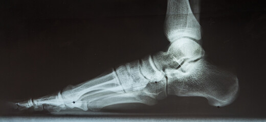 X-ray of the male foot to determine flat feet