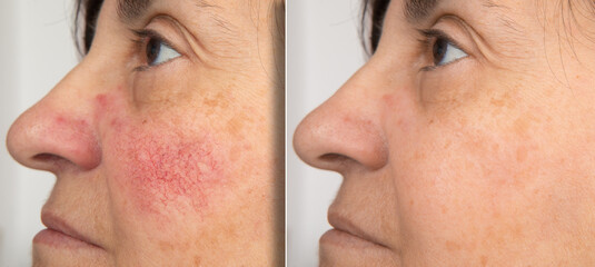 A close-up portrait of before and after a mature woman showing redness on her cheeks. The concept...
