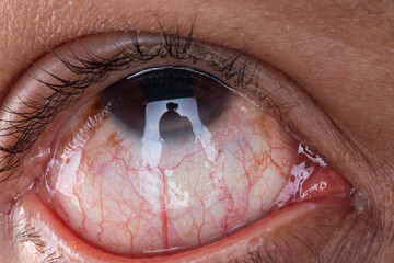 Closeup of Asian man irritated red bloodshot eye