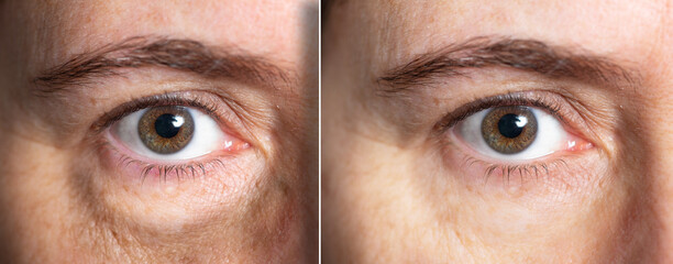 Eye bags before and after cosmetic treatment