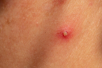 A close up view of pus filled spots on caucasian skin, clustered