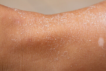 Close up human skin epidermis texture with flaking and cracked particles