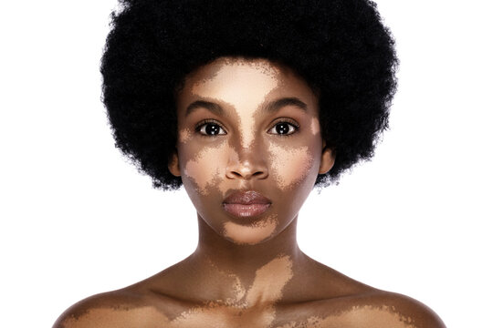 Beautiful black woman with vitiligo skin disorder