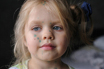 Little girl suffers from chickenpox