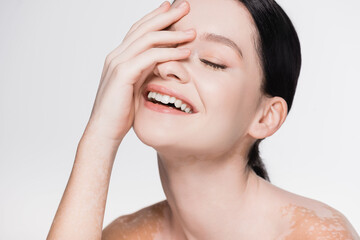 Naklejka premium smiling young beautiful woman with vitiligo isolated on white
