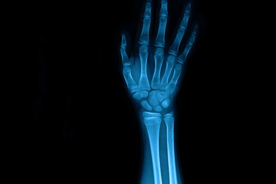 X-ray bone of the hand and feet Represents muscle and bone inflammation, medical studies.