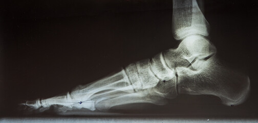 X-ray of the male foot to determine flat feet