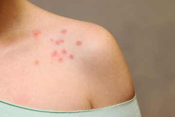 The concept of Allergy. Shoulder with rash on white background