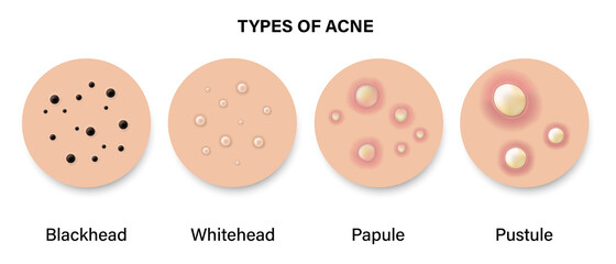 Type of acne diagram, Skin acne on top view, Blackhead, Whitehead, Papule, Pustule, Skin problems