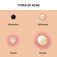 Type of acne diagram, Skin acne on top view, Blackhead, Whitehead, Papule, Pustule, Skin problems