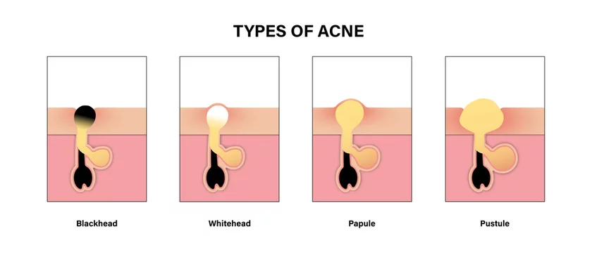 Type of acne diagram, Blackhead, Whitehead, Papule, Pustule, Skin problems  Stock Vector | Adobe Stock