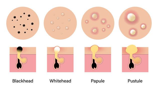 Type of acne diagram, Blackhead, Whitehead, Papule, Pustule, Skin problems