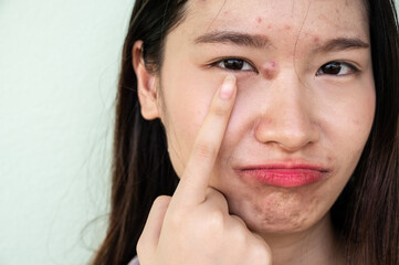 Worried Asian woman pointing hard pimple (or Elephant head acne) with acne inflamed on her face.