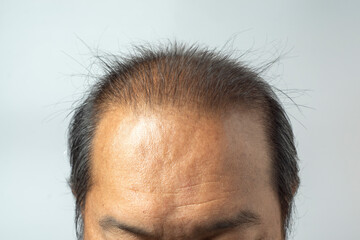 front view, men head with hair loss symptoms, serious hair loss problem